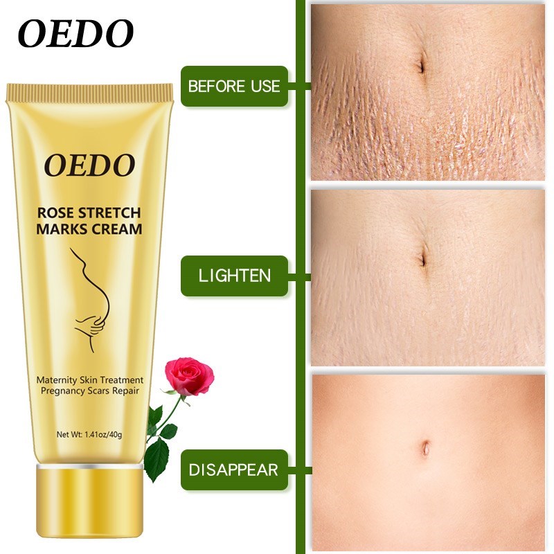 Stretch Mark Cream