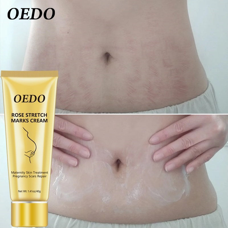 Stretch Mark Cream